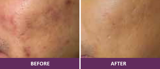 Acne and Acne Scar Treatment