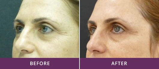 SKIN REJUVENATION