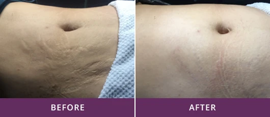 SKIN TIGHTENING