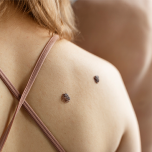 CryoPen is an effective treatment for warts and skin tags.