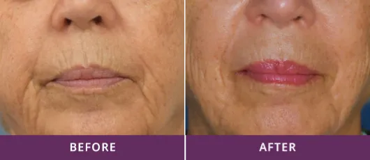 Cellenis-PRP-B&A-1 Cellenis PRP, distributed by SpectruMed