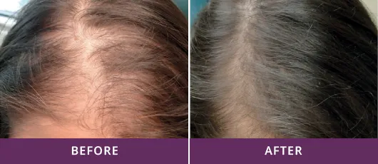 Cellenis-PRP-B&A-2 Cellenis PRP, distributed by SpectruMed