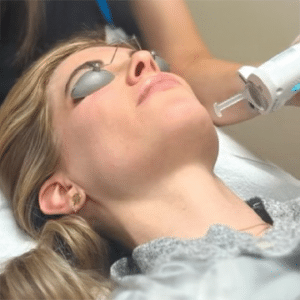 Treatment Photo of PicoV, a combination of PicoSure Pro and DermaV.