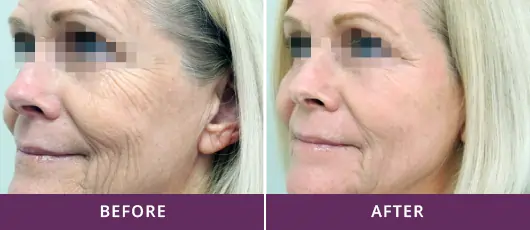 SCAR IMPROVEMENT